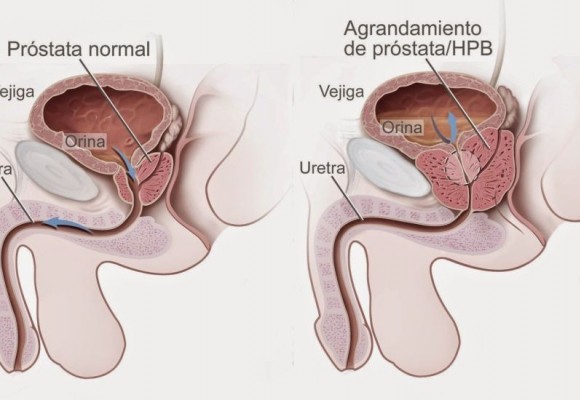 El cáncer de próstata, tan cercano y tan lejano.