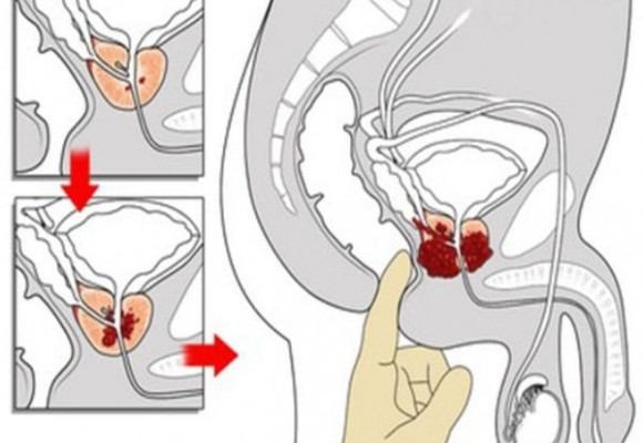 El cáncer de próstata, tan cercano y tan lejano.